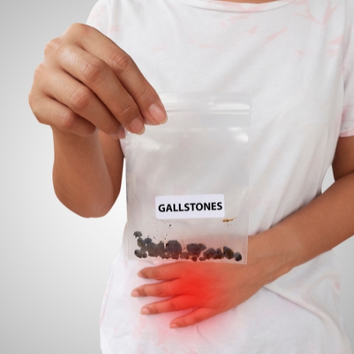 Gallstones - Healix Hospitals